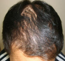 発毛実績98％のスーパースカルプ発毛療法で薄毛やAGAケア・安心の返金保証コース