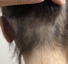 スーパースカルプ発毛センター　宇城店　熊本　発毛　抜け毛の悩み　育毛　円形脱毛症　女性の薄毛　抜け毛　産後の悩み