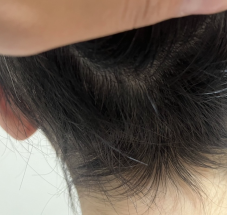 スーパースカルプ発毛センター　宇城店　熊本　発毛　抜け毛の悩み　育毛　円形脱毛症　女性の薄毛　抜け毛　産後の悩み