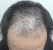 画像 スーパースカルプ発毛センター 熊本 宇城店 育毛 抜け毛の悩み 女性の抜け毛 薄毛