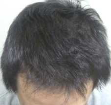 画像 スーパースカルプ発毛センター 熊本 宇城店 育毛 抜け毛の悩み 女性の抜け毛 薄毛