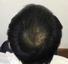 画像 スーパースカルプ発毛 熊本 宇城店 松橋 発毛 育毛 薄毛 産後の悩み 女性の薄毛