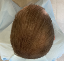 画像 スーパースカルプ発毛 熊本 宇城店 松橋 発毛 育毛 薄毛 産後の悩み 女性の薄毛