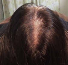 画像 スーパースカルプ発毛 熊本 宇城店 松橋 発毛 育毛 薄毛 産後の悩み 女性の薄毛