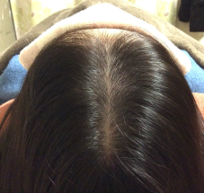 画像 スーパースカルプ発毛 熊本 宇城店 松橋 発毛 育毛 薄毛 産後の悩み 女性の薄毛