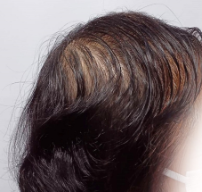 画像 スーパースカルプ発毛センター 熊本 宇城店 育毛 抜け毛の悩み 女性の抜け毛 薄毛