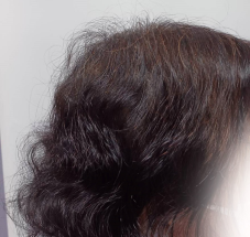 画像 スーパースカルプ発毛センター 熊本 宇城店 育毛 抜け毛の悩み 女性の抜け毛 薄毛